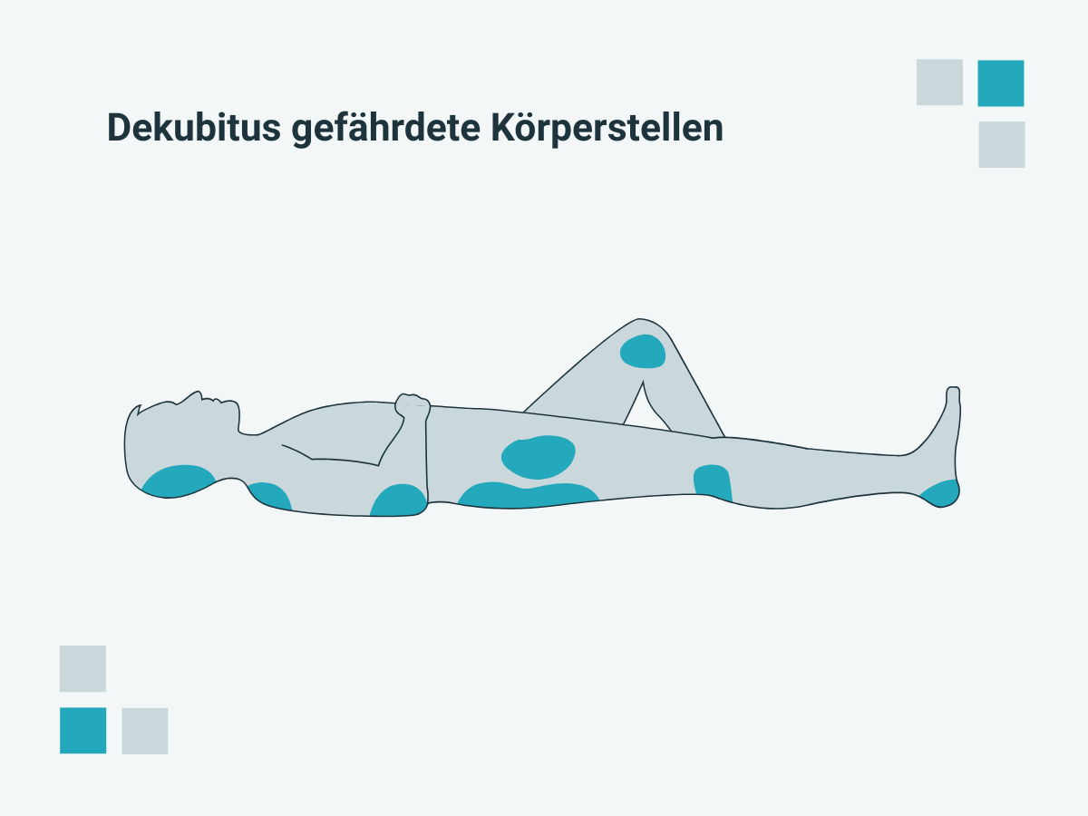 Besonders für Dekubitus gefährdet sind die Körperstellen, an denen Knochen direkt unter Haut liegen und auf die beim Sitzen oder Liegen dauerhaft das Körpergewicht drückt. Je nach Position zählen dazu der Hinterkopf, die Schulterblätter, das Steißbein und die Fersen sowie die Ellbogen und das Sitzbein.